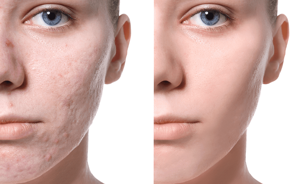 laser treatment for face marks