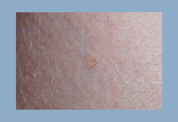 Basal Cell Carcinoma treatment