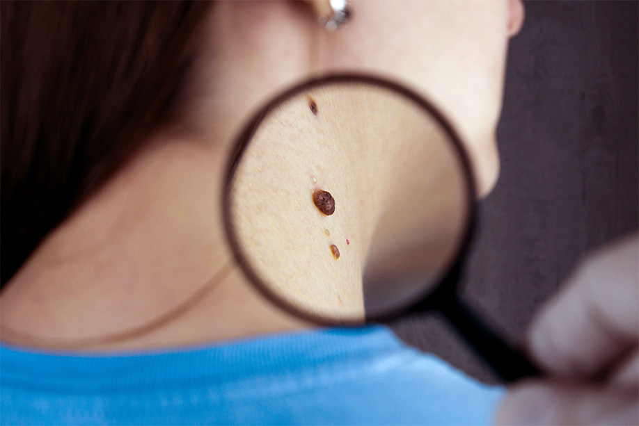 blog-skin-cancer
